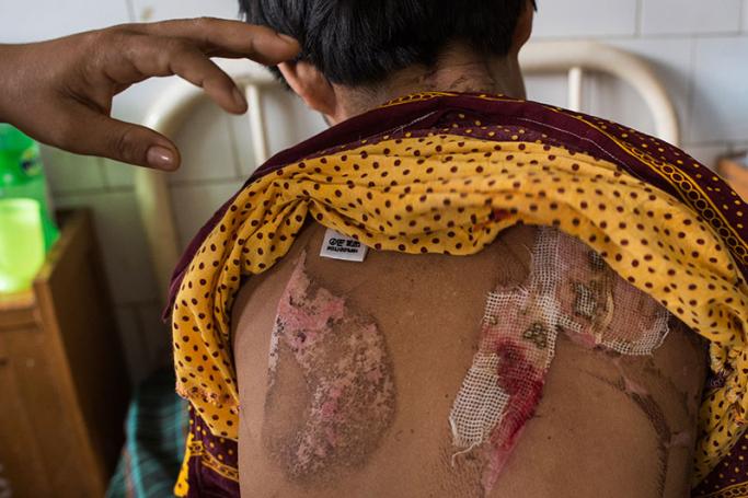 This picture taken on June 6, 2017 shows Myat Noe, whose name has been changed to protect her identity, with burns on her back in the Sanpya hospital in Yangon. Photo: Ye Aung Thu/AFP
