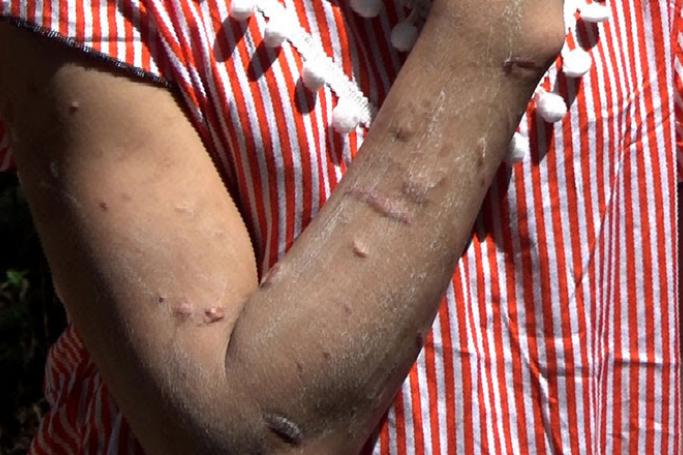San Kay Khine shown her injuries from the tortures.
